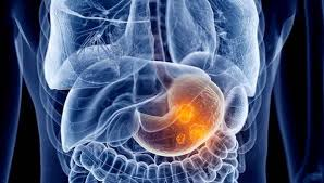 Cancerul cauzează milioane de decese în fiecare an. Cele mai frecvente tipuri de cancer la nivel mondial