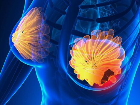 Cancerul cauzează milioane de decese în fiecare an. Cele mai frecvente tipuri de cancer la nivel mondial